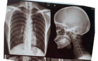 تفسیر فیلم رادیوگرافی با استفاده از هوش مصنوعی و روشهای پردازش تصویر